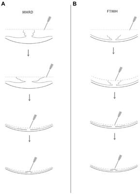 Petaloid technique and prognostic significance of macular hole shapes by optical coherence tomography for full thickness macular hole